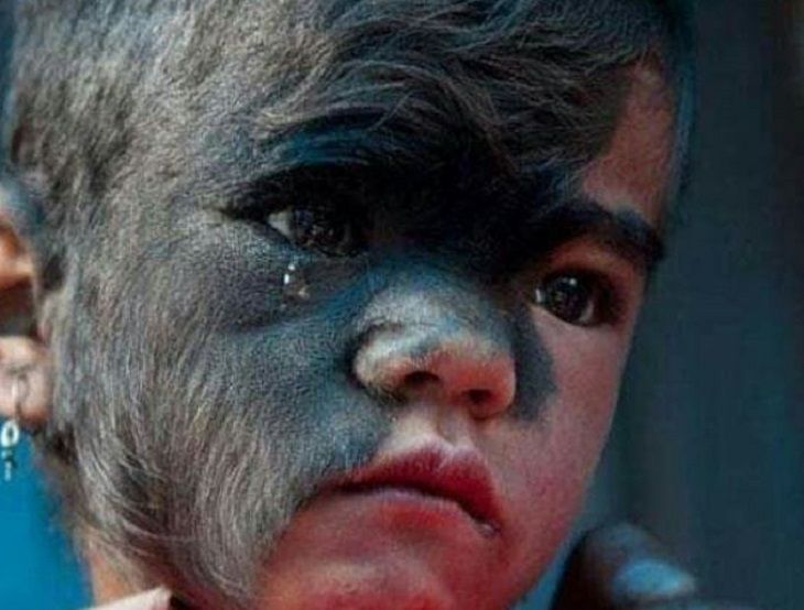 «Синдром оборотня»:16 детей обросли волосами после приема лекарства