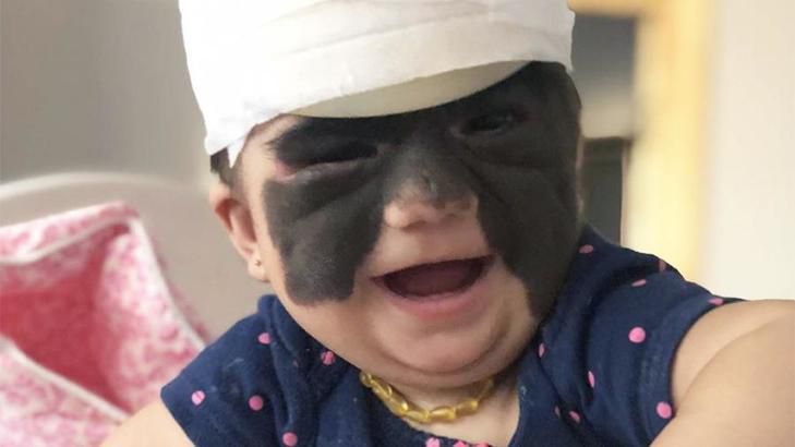 Мама девочки с «маской Бэтмена» впервые показала результат операций