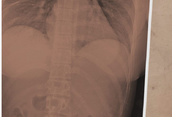 Силиконовая грудь спасла женщине жизнь фото