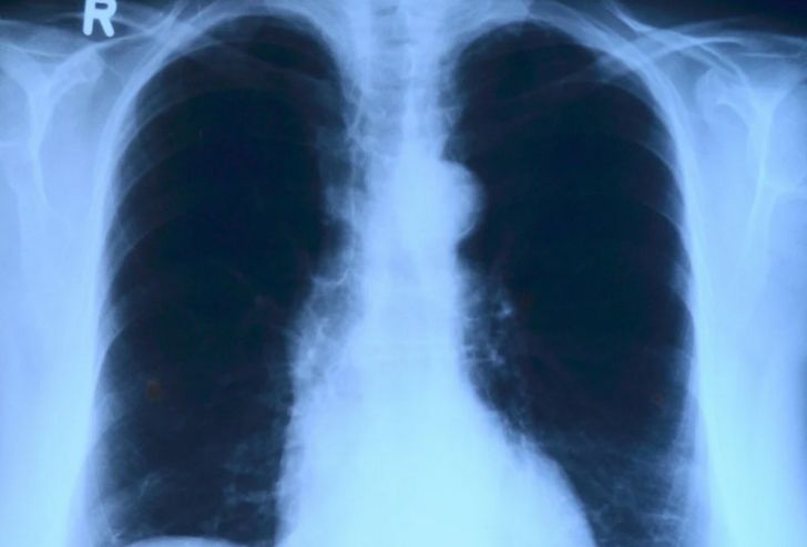 Ученые выяснили происхождение рака легких у некурящих