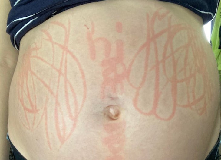 Рисунки на животе: Девушке пришлось заболеть, чтобы стать холстом
