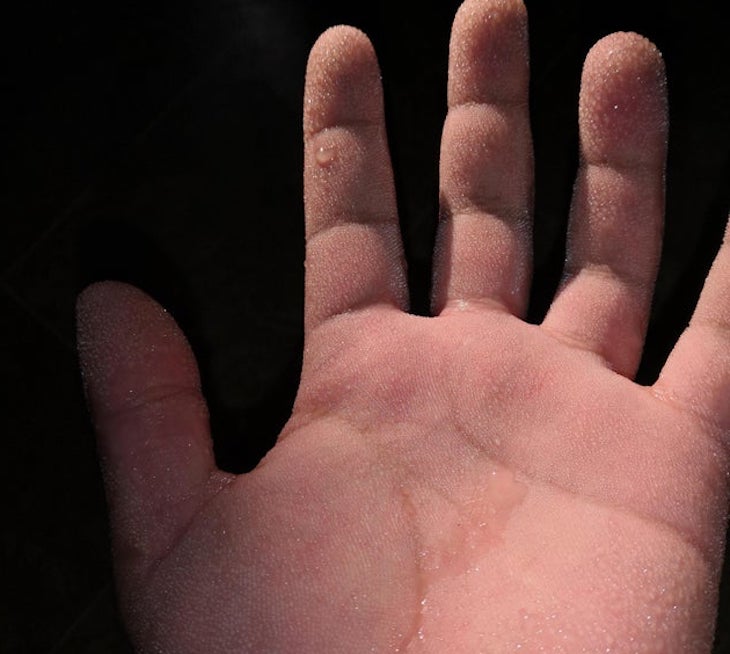 Не волшебство, а болезнь: Парень может создавать воду из ничего Не волшебство, а болезнь: Парень может создавать воду из ничего