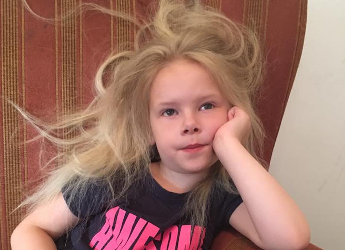 Редкая аномалия: Девочку впервые расчесали в 9 лет