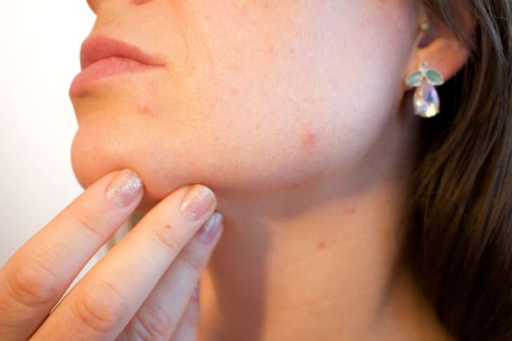 How to get rid of acne: foods to include in your diet woman