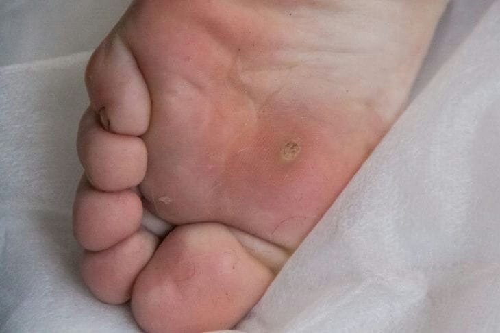 Врага нужно знать в лицо: какие бывают мозоли Нога