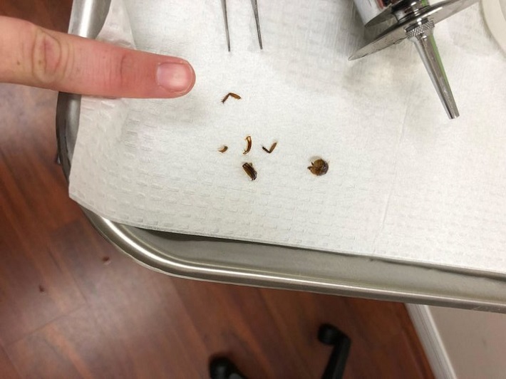 Посторонние предметы в ухе. Как вытащить таракана из уха. Извлечение инородного тела из уха. Насекомое которое заползает в ухо. Как вытащить таракана из уха.