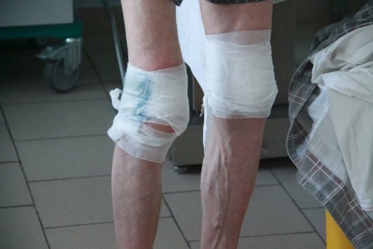 Высокий рост повышает вероятность развития варикозного расширения вен