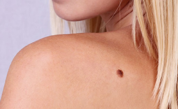 Косметолог разглядела на теле клиентки признак рака и спасла ей жизнь