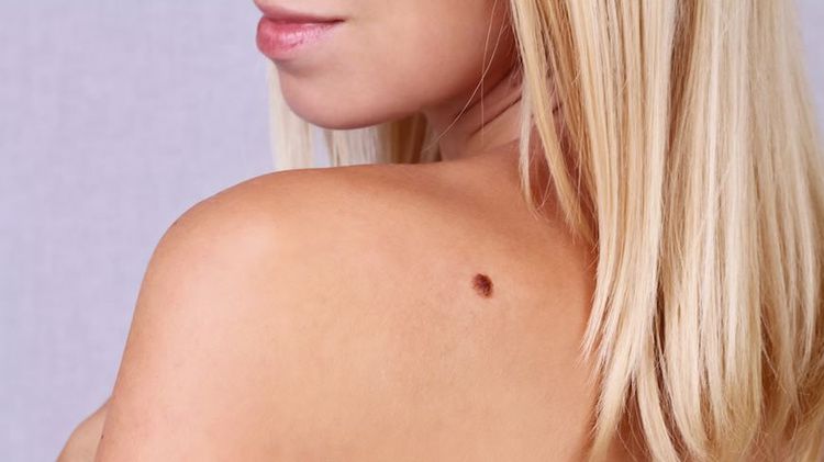 Врачи назвали пять симптомов «плохой» родинки Врачи назвали пять симптомов «плохой» родинки