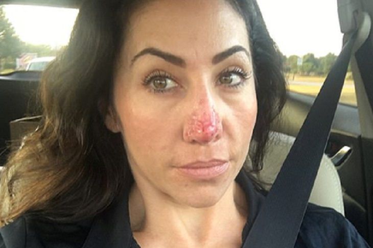 У женщины вырос огромный нос: она стала затворницей  