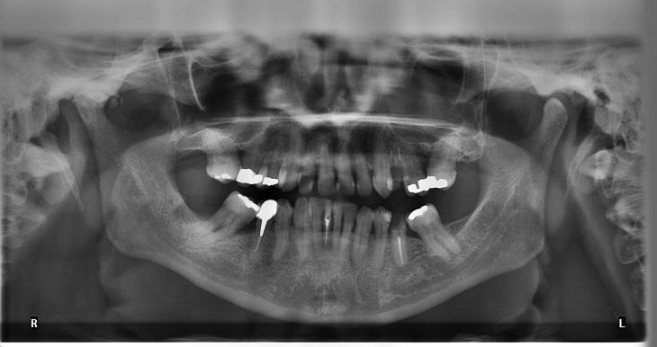 Специалисты: новый материал увеличит срок службы пломб в два раза