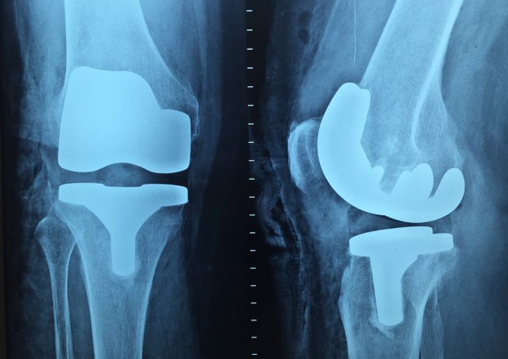 Ортопеды назвали эффективные способы борьбы с плоскостопием