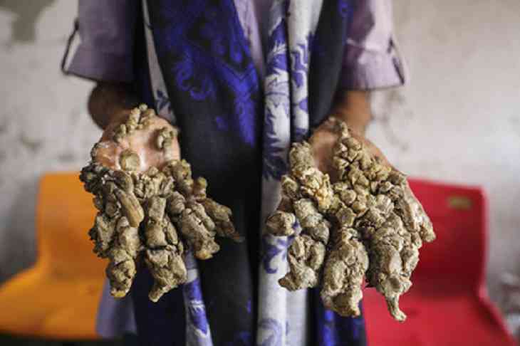 Страдающий редчайшим заболеванием «человек-дерево» захотел лишиться рук