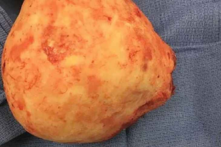 Врачи удалили из мочевого пузыря пациентки огромный камень, который мешал ей жить