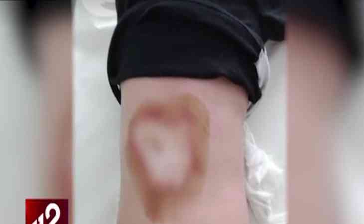 11-летнего мальчика подожгли другие дети: их не накажут