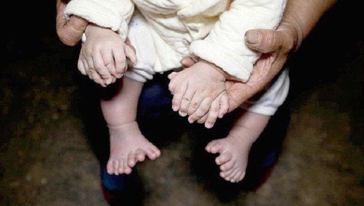 Родился ребенок с 31 пальцем. Врачи говорят, что это генетика
