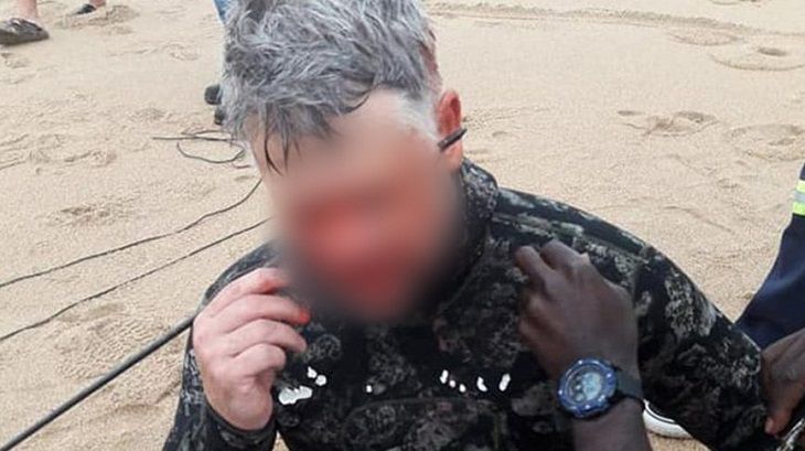 Мужчина выстрелил себе в голову гарпуном и выжил Мужчина выстрелил себе в голову гарпуном и выжил