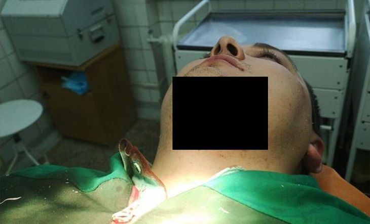 Африканца, откусившего часть подбородка парню из Новополоцка, депортировали из Беларуси