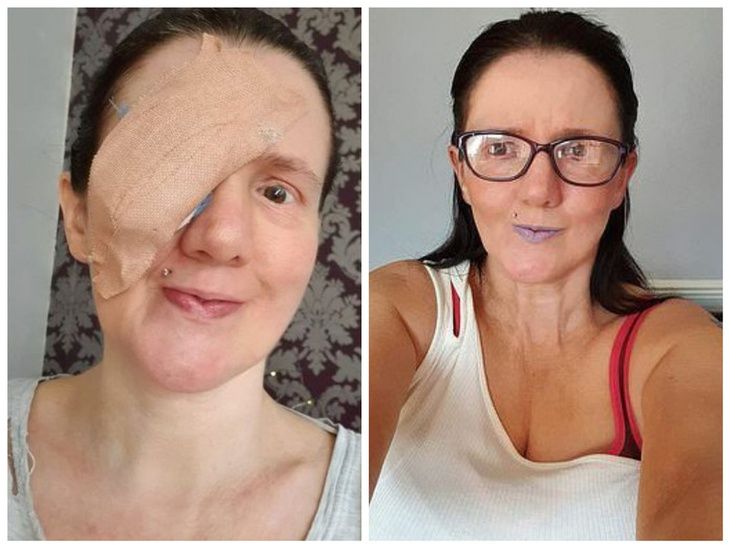 Женщина лишилась глаза из-за нелепой случайности с полотенцем