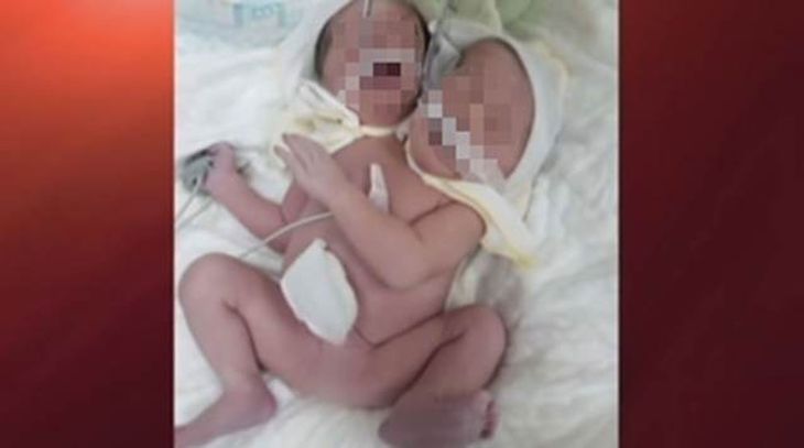 Появилось фото двухголового ребенка, который родился в Украине