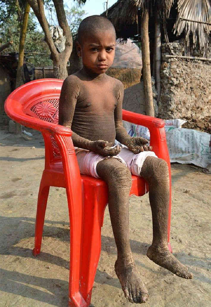 Врачи не знают, как помочь каменеющему мальчику из Бангладеш