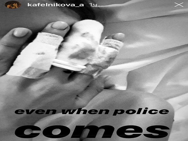 Алеся Кафельникова экстренно госпитализирована с многочисленными переломами