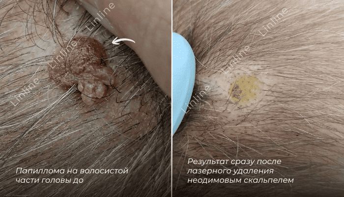 удаление папиллом
