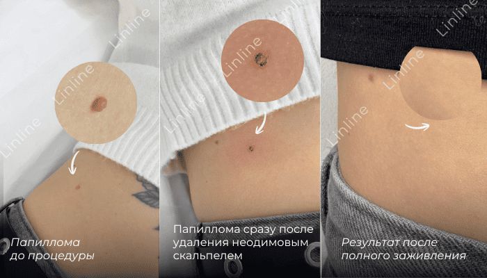 удаление папиллом