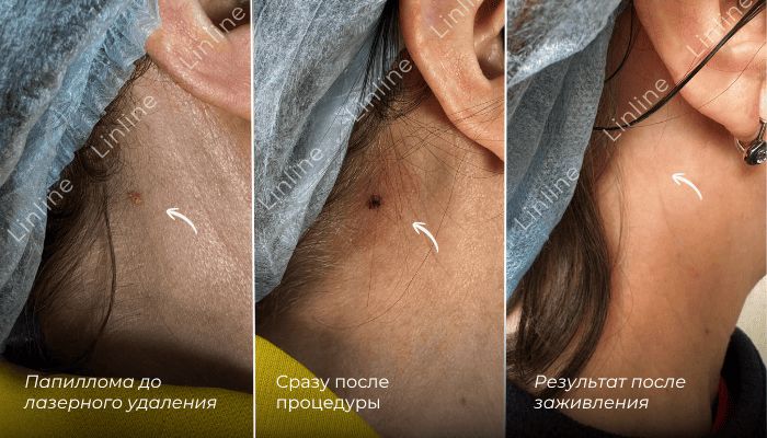 удаление папиллом