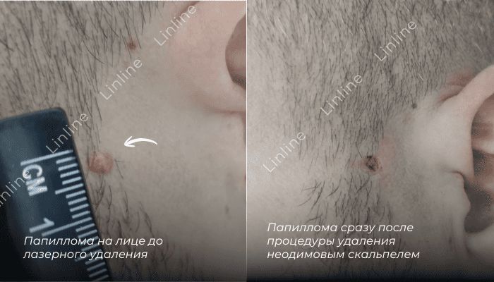 удаление папиллом