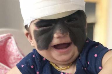 Мама девочки с «маской Бэтмена» впервые показала результат операций