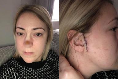 Женщина игнорировала точку на носу, пока ее не пришлось удалить вместе с кожей