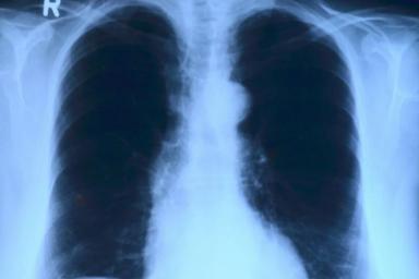 Ученые выяснили происхождение рака легких у некурящих