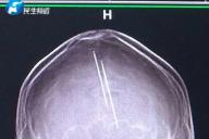 Вещдок в голове: Женщина пошла к врачу, а в итоге оказалась в полиции