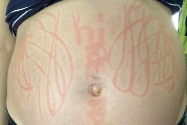 Рисунки на животе: Девушке пришлось заболеть, чтобы стать холстом