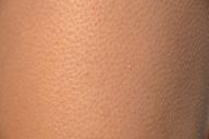 Гусиная кожа