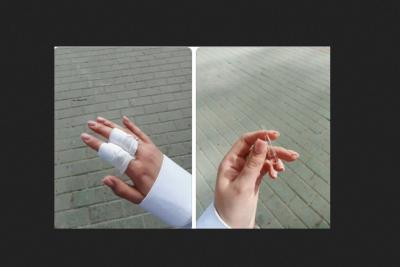 травмированные пальцы