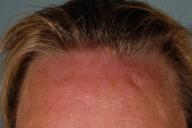 Женщина вернулась из отпуска с личинкой тропической мухи во лбу