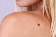 Косметолог разглядела на теле клиентки признак рака и спасла ей жизнь