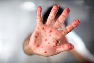 В Японии зарегистрировали сильнейшую вспышку кори за последние 10 лет