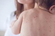 Из-за вспышки кори в пригороде Нью-Йорка объявлено чрезвычайное положение