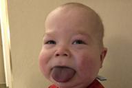 Грудному ребенку укоротили слишком длинный язык