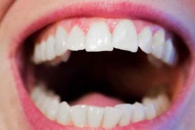 Мужчина почти 30 лет прожил с болтами вместо зубов