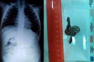 Врачи вытащили из желудка 3-летней девочки ключи от почтового ящика