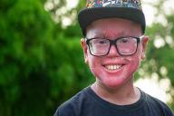 Мальчик сбрасывает кожу как змея: генетическая аномалия