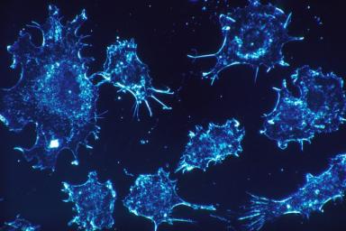 Лазер против раковых клеток: в США разработана новая технология лечения