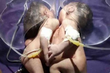 Одно сердце на двоих: в Индии родились необычные сиамские близнецы