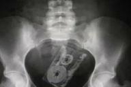 Врачи поделились снимками странных предметов внутри людей