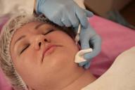 Лицо женщины покрылось фурункулами из-за филлеров