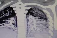 «В 19 лет легкие, как у 60-летнего старика»: Врач показал, как вейп влияет на организм